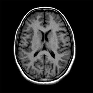 brain ct scan